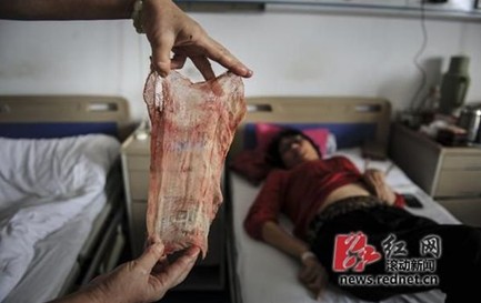 9月2日，湖南省胸科(结核病)医院，张女士躺在医院接受治疗，医院在张女士身上取出一块纱布，疑为数月前手术留下